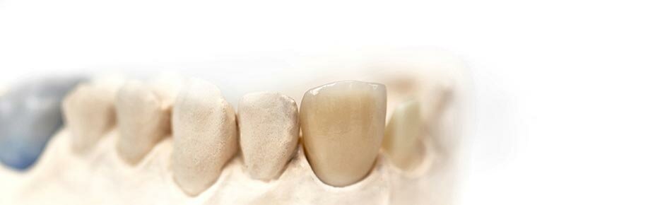 Зубные коронки | Клиника стоматологии Хардер и Мель, Мюнхен