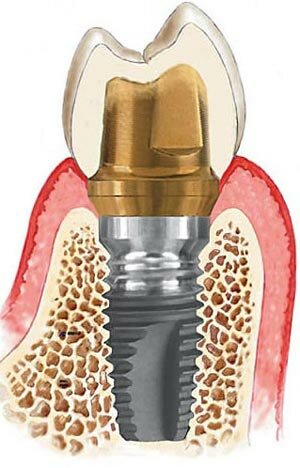 Зубные имплантаты | Клиника стоматологии Хардер и Мель, Мюнхен