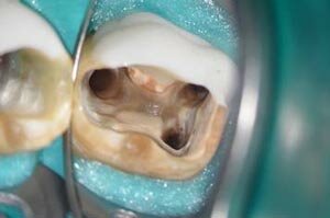 Лечение канала зубов | Клиника стоматологии Хардер и Мель, Мюнхен