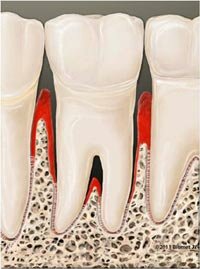 Лечение пародонтоза | Клиника стоматологии Хардер и Мель, Мюнхен
